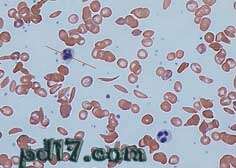 十种可怕的疾病Top3：镰状细胞贫血