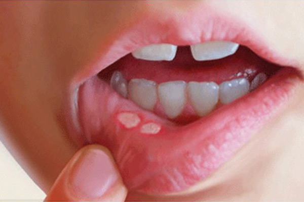 口腔溃疡图片，引起口腔溃疡的原因有哪些